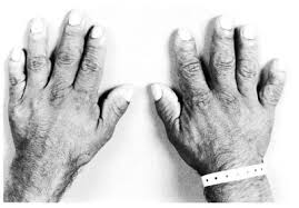 To đầu chi - Hình ảnh minh họa